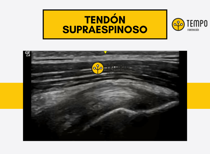 tendon-supraespinoso-aprende-a-valorarlo-ecografia